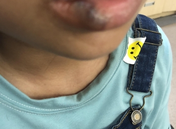 血管瘤硬化治疗前后