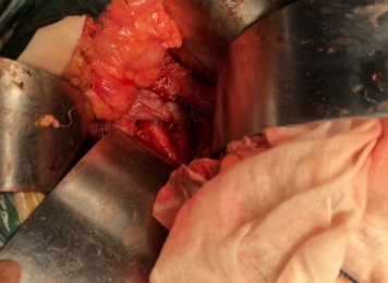 肿瘤切除肾静脉重建