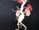 腹主动脉瘤1