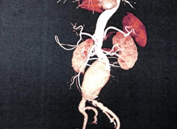 主动脉瘤开放手术及腔内修复术