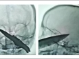 神经外科团队联合多学科成功救治一位锐器伤致复杂开放性颅脑损伤患者