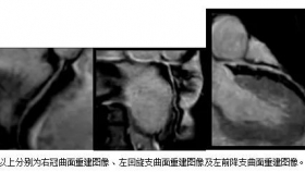 贵州省首例无创不打药冠脉磁共振血管造影在贵医附院完成