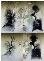 新突破，中山一院贵州医院介入科成功为患者实施肺动脉球囊扩张术