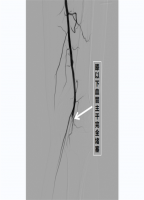 保腿更保命，贵医附院介入科成功救治下肢动脉急性缺血患者