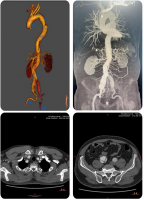 贵医附院血管外科团队成功为复杂主动脉夹层患者重建生命通道