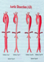 贵医附院心脏大血管外科成功救治一名产后主动脉夹层患者