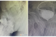 【厚德精医】后尿道断裂，造瘘不是长久之计——贵医附院泌尿外科开展复杂性下尿路修复重建手术