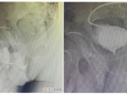 【厚德精医】后尿道断裂，造瘘不是长久之计——437ccm必赢泌尿外科开展复杂性下尿路修复重建手术