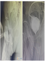 【厚德精医】后尿道断裂，造瘘不是长久之计——贵医附院泌尿外科开展复杂性下尿路修复重建手术