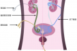 【厚德精医】小小结石背后的致命威胁，警惕泌尿系结石并发症——尿源性脓毒症
