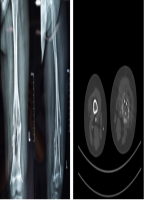 贵州首例！贵医附院骨科肿瘤团队成功实施3D打印儿童仿生型肿瘤假体置换手术