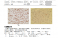 贵州首例！贵医附院骨科肿瘤团队成功实施高难度 3D 打印肿瘤假体置换手术