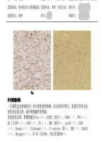 贵州首例！贵医附院骨科肿瘤团队成功实施高难度 3D 打印肿瘤假体置换手术