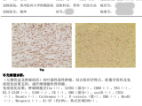 贵州首例！贵医附院骨科肿瘤团队成功实施高难度 3D 打印肿瘤假体置换手术