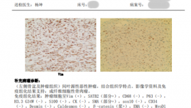 贵州首例！贵医附院骨科肿瘤团队成功实施高难度 3D 打印肿瘤假体置换手术