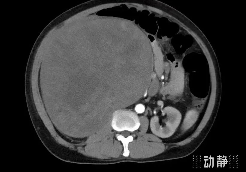 【媒体贵医】22厘米腹膜后巨瘤“炸弹”成功“拆除”