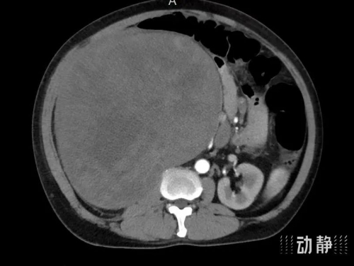 【媒体贵医】22厘米腹膜后巨瘤“炸弹”成功“拆除”
