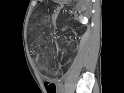 【媒体贵医】10.4公斤篮球大小肿瘤破裂，贵医附院多学科协作成功切除